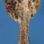 Humoral osteosarcoma after formalin fixation