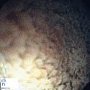 Chylomicron retention disease (Duodenal endoscopy)