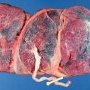 Trichorionic triamniotic placenta