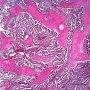 Embryonal carcinoma