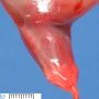Sirenomelia