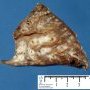 Bronchiectasis and BALT hyperplasia (Case 11750)