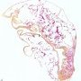 subpleural bulla in Marfan disease