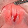 Sexual ambiguity and perineal hypospadias in mosaic monosomy X (...)