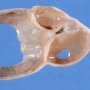 Ovarian cystic juvenile granulosa tumor
