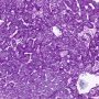 Niemann-Pick disease type B (NPB) (PAS)