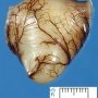 Intestinal duplication cyst