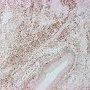 Embryonal botryoid rhabdomyosarcoma of the rhinopharynx (myogenin)