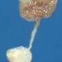 Renal adysplasia (renal agenesis and renal dysplasia)