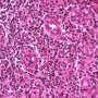 Acute inflammation with granulocytic diapedesis in ileal Crohn (...)