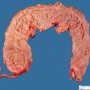 Normal open colon in colonic dysmotility