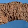 Colectomy of ulcerative colitis