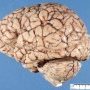 Normal brain