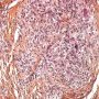 Plexiform fibrohistiocytic tumor