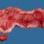Crohn ileitis (Ileal Crohn disease)