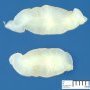 Neurofibroma