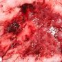 Crohn ileitis and colitis (ileocaecal region)