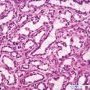 Clear cell papillary renal cell carcinoma