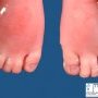 Foot post-axial polydactyly and syndactyly 2-3 in Smith-Lemli-Opitz (...)