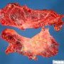Splenic mesothelial cyst (open)