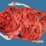Triple pregnancy placenta