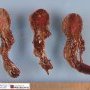 Intestinal intussusception in Peutz-Jeghers syndrome: necrotic (...)