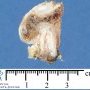 Osteochondroma