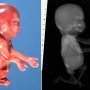 Caudal regression syndrome with lombosacral agenesis