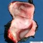Duodenal duplication cyst