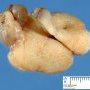 Nasal inflammatory pseudopolyp