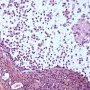 Salivary mucocele