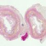 Neonatal necrotizing enterocolitis