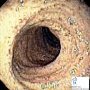 Chylomicron retention disease (Duodenal endoscopy)