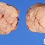 Mammary fibroadenoma