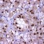 TFEB positivity in HMB45+ renal cell tumor