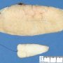Mammary fibroadenoma