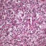 Foamy macrophages in splenic red pulp