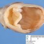 Ileal duplication cyst