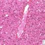 Normal central vein