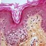 Cutaneous GVHD grade 2