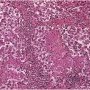 Thymic seminoma