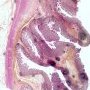Colonic stenosis in Crohn disease