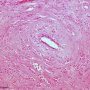 Invasive lobular carcinoma of the breast (Credit Ed Uthman)