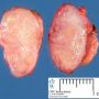 Sclerosing nodular Hodgkin disease