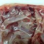 Ovarian mucinous cystadenoma