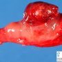 Tubal rupture during tubal pregnancy
