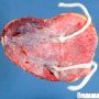 Monochorionic monoamniotic gemellar placenta