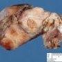 Nasal juvenile angiofibroma