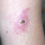 Cutaneous leishmaniasis