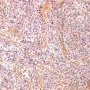 Plexiform fibrohistiocytic tumor